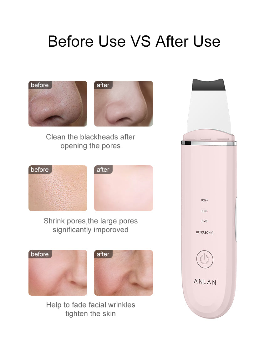 Ultrasonic Skin Scrubber - Premium Beauty Device - Just $29! Shop now at elinsse